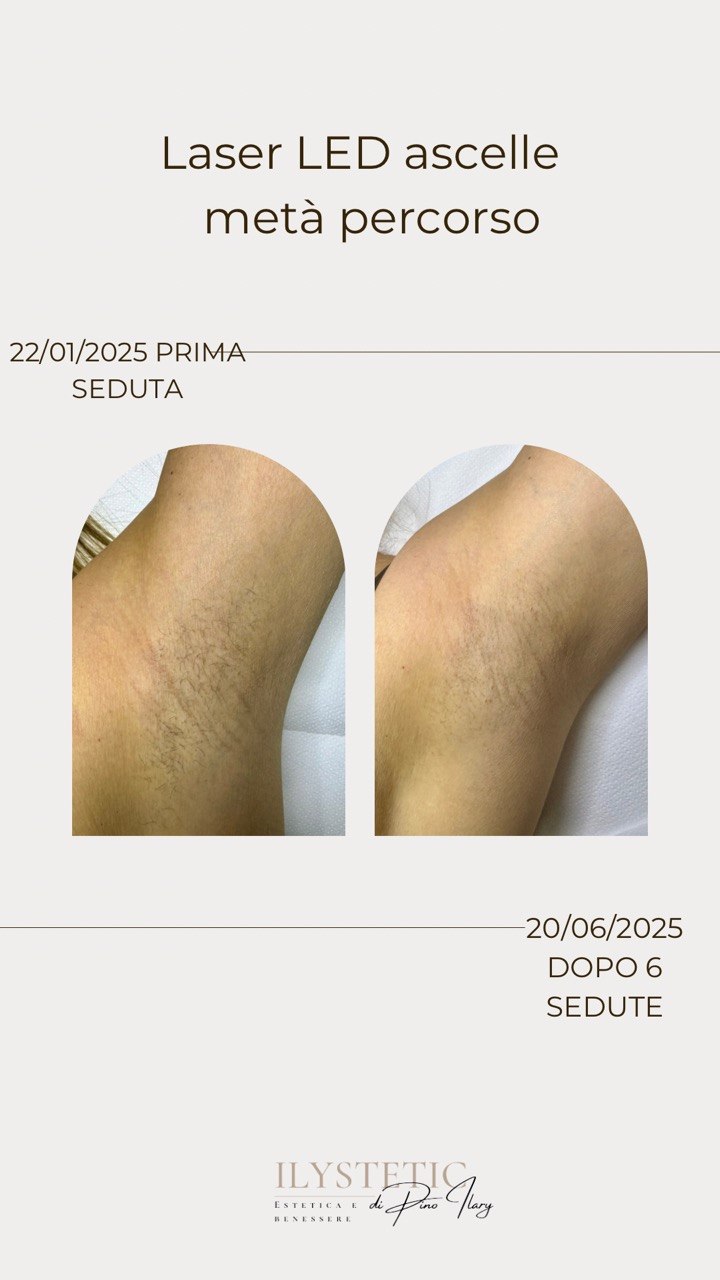 Confronto delle ascelle prima e durante un percorso laser LED