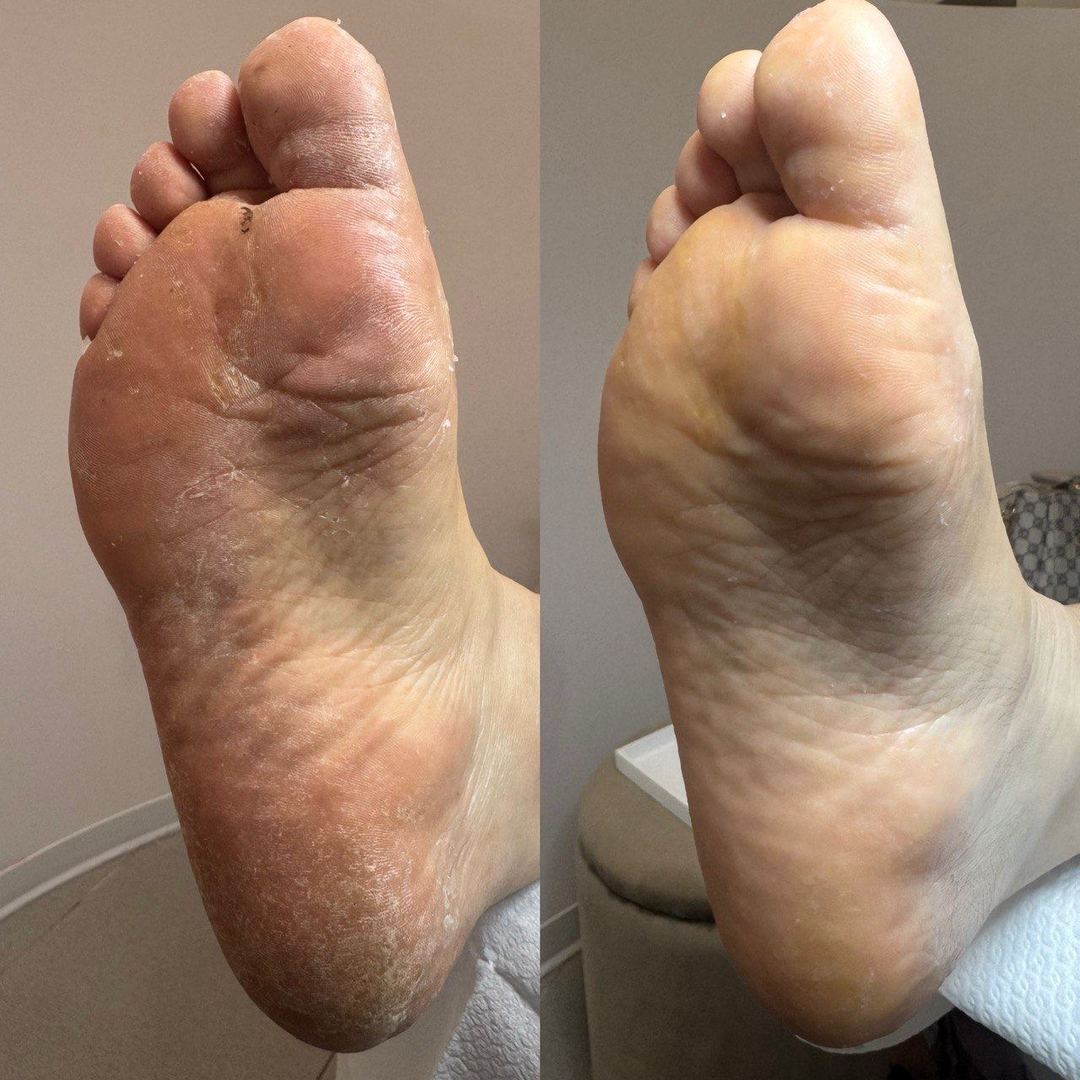 Piedi prima e dopo il trattamento Calluspeeling Mavex